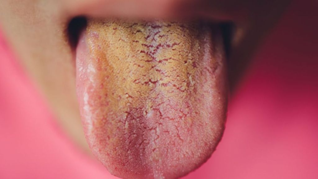 जीभ है हमारी सेहत का आइना: Tongue Health