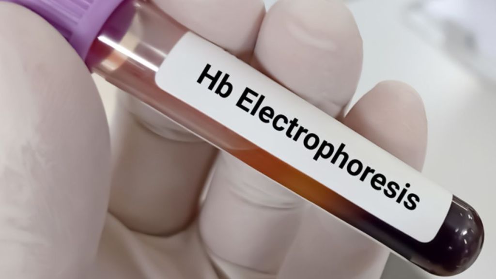 Hb Electrophoresis Thalassemia Test