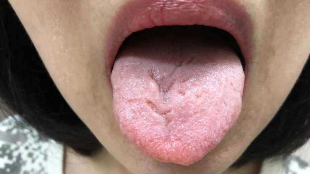 Tongue Color and Health