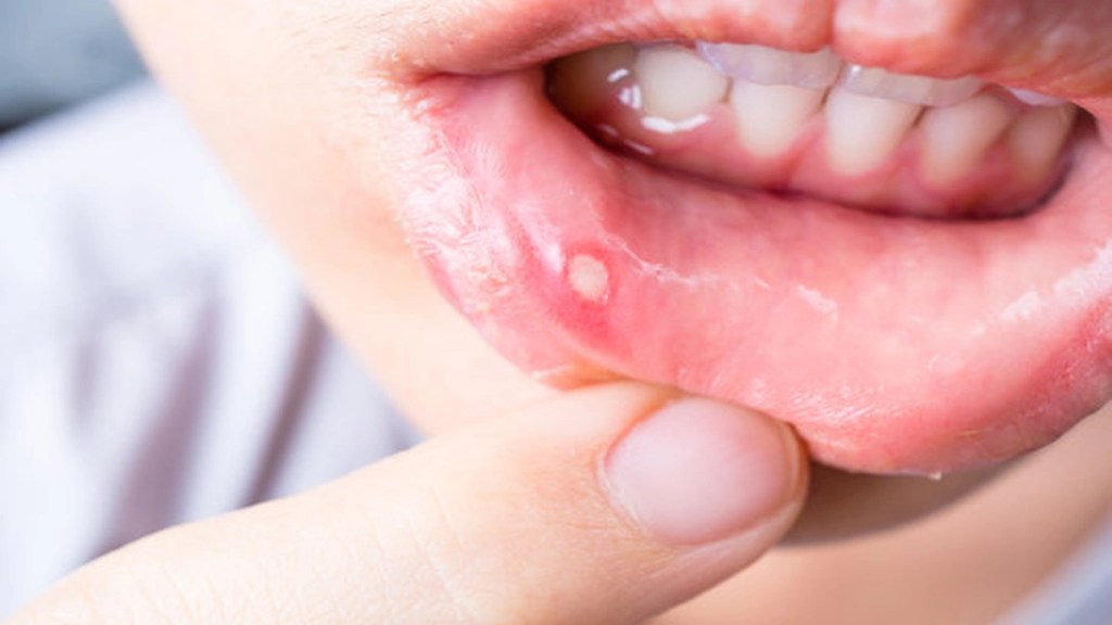 इन घरेलू नुस्खों से करें मुंह के छालों को ठीक: Remedies For Mouth Ulcers
