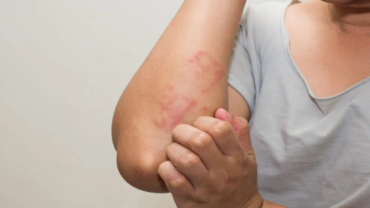 कई तरह की होती है एलर्जी, कैसे करें बचाव: Allergy Types and Prevention