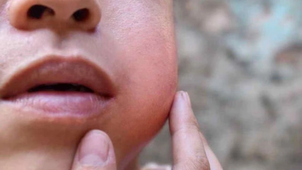 Identify of Mumps Disease